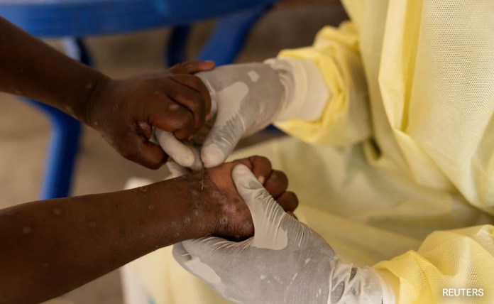 WHO Mengatakan Droplet Merupakan Rute Kecil Penyebaran Mpox. Apa yang Kita Ketahui Sejauh Ini WHO Mengatakan Droplet Merupakan Rute Kecil Penyebaran Mpox. Apa yang Kita Ketahui Sejauh Ini